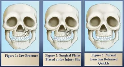 An illustration of jaw fracture